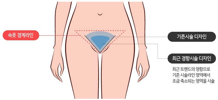 하복부 그림 위에 속옷 경계선(빨간 점선), 예전 이식 범위(넓은 역삼각형), 요즘 이식 범위(작은 역삼각형)를 표시한 도식