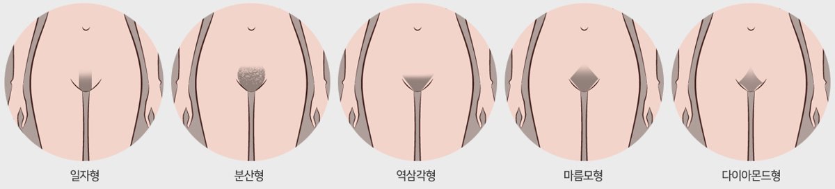 하복부 그림에 일자형, 분산형, 역삼각형, 마름모형, 다이아몬드형 다섯 가지 음모 이식 디자인을 나란히 그린 도식