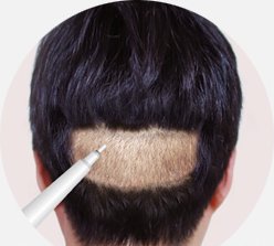 뒷머리 아래쪽 가로 띠 모양 부위에서 모낭을 채취하는 과정 그림