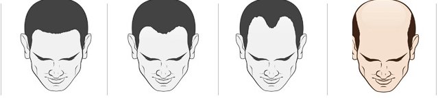 남성 탈모 진행 단계 그림 네 개, 정수리까지 넓게 빠진 마지막 단계를 색으로 강조
