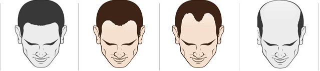 남성 탈모 진행 단계 그림 네 개, 이마 양옆이 올라가는 가운데 두 단계를 색으로 강조