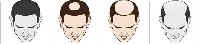 남성 탈모 진행 단계 그림 네 개, 정수리가 둥글게 비는 가운데 두 단계를 색으로 강조