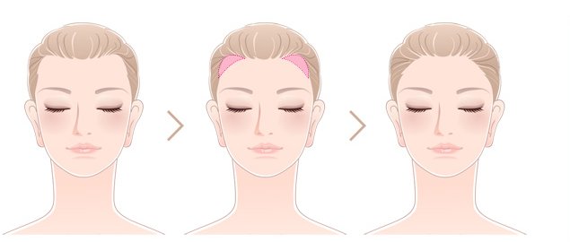 M자·사각형 이마 여성의 헤어라인 교정 과정 일러스트 — 교정 전, 이식 부위, 교정 후