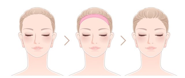 이마가 전체적으로 넓은 여성의 헤어라인 교정 과정 일러스트 — 교정 전, 이식 부위, 교정 후