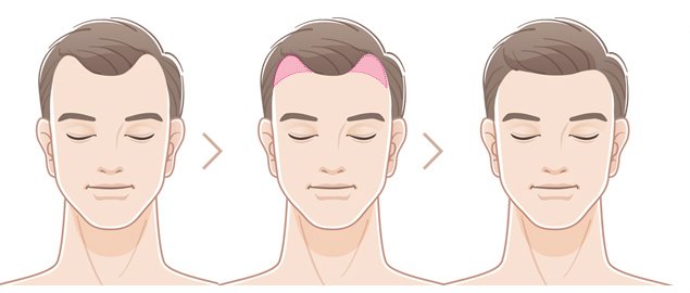 M자 이마 남성의 헤어라인 교정 과정 일러스트 — 교정 전, 이식 부위, 교정 후