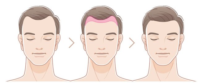 이마가 전체적으로 넓은 남성의 헤어라인 교정 과정 일러스트 — 교정 전, 이식 부위, 교정 후