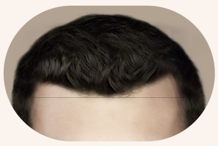 남성 M자 헤어라인 유형 — 모서리가 각진 M자 이마
