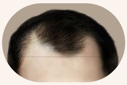 남성 M자 헤어라인 유형 — 모서리가 둥글게 올라간 이마