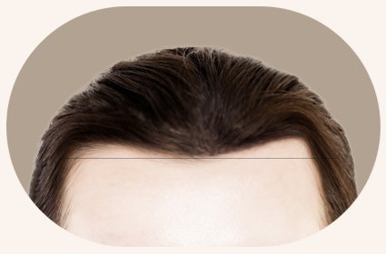 여성 M자 헤어라인 예시