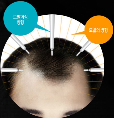 헤어라인 위에 부위별 모발 방향과 이식 방향을 화살표로 표시한 도식